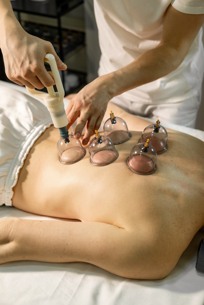 What is Cupping?